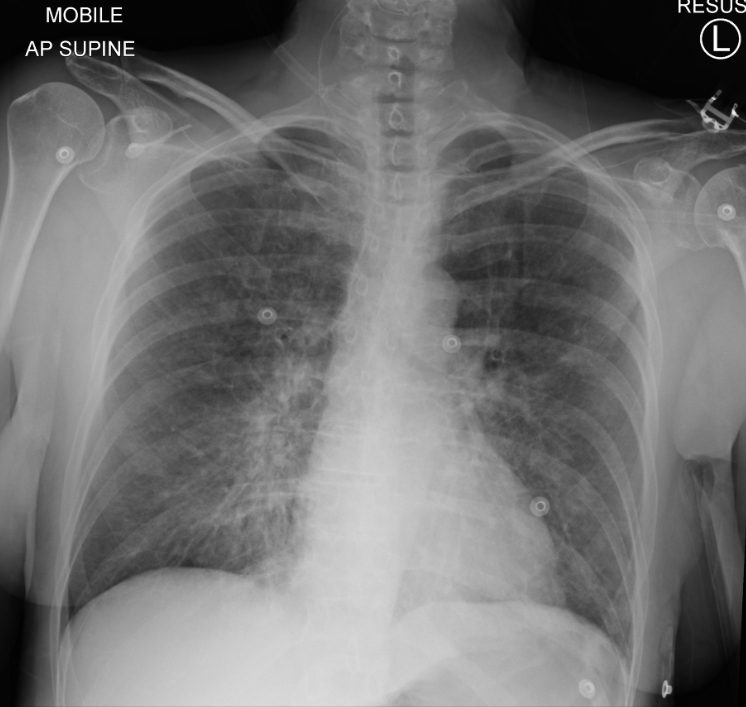 Chest X-ray showing oedema in the lungs (fluffy white shadowing)